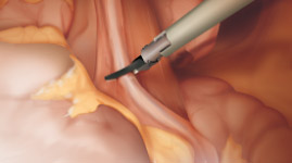 組織游離（超聲手術刀系統）